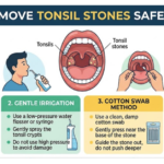 How to Remove Tonsil Stones Safely at Home